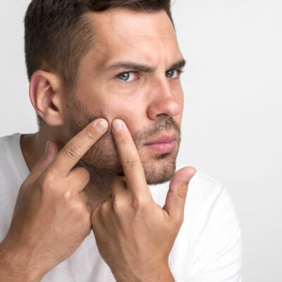 Smart Tips to Naturally Fight Acne in Men