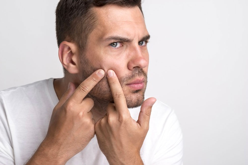 Smart Tips to Naturally Fight Acne in Men